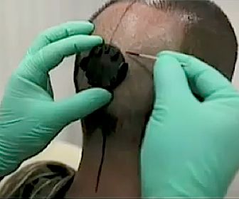 Professor laat camera in achterhoofd implanteren