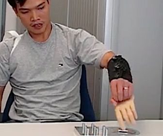 Hightech handprothese uit Delft