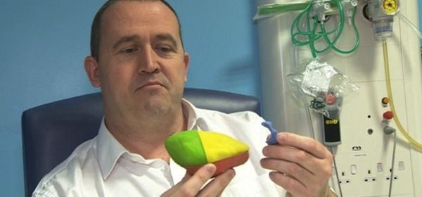 Patiënt helpt doktoren door zijn nier in 3d te printen