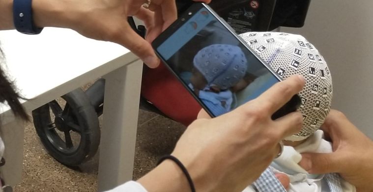 Artsen meten babyschedels met smartphone-app