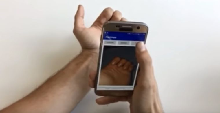 App herkent bloedarmoede aan foto's van nagels
